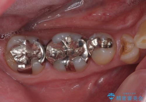 金属の詰め物が取れた　オールセラミッククラウンの症例 治療前