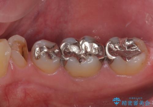 金属の詰め物が取れた オールセラミッククラウンの治療前