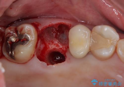 割れてしまった奥歯　1DAYインプラント治療の治療中