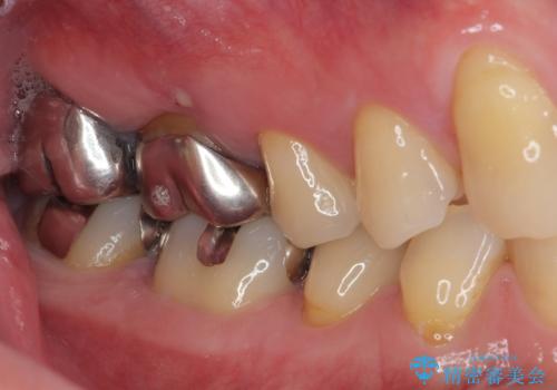 金属の詰め物が取れた オールセラミッククラウンの治療前