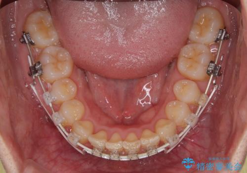 隠れた前歯が気になる ディープバイトのワイヤー矯正治療の治療中