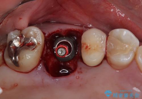 割れてしまった奥歯　1DAYインプラント治療の治療後