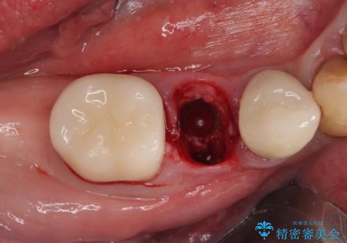 破折してしまった奥歯　抜歯即時埋入で短期間インプラント治療の治療後