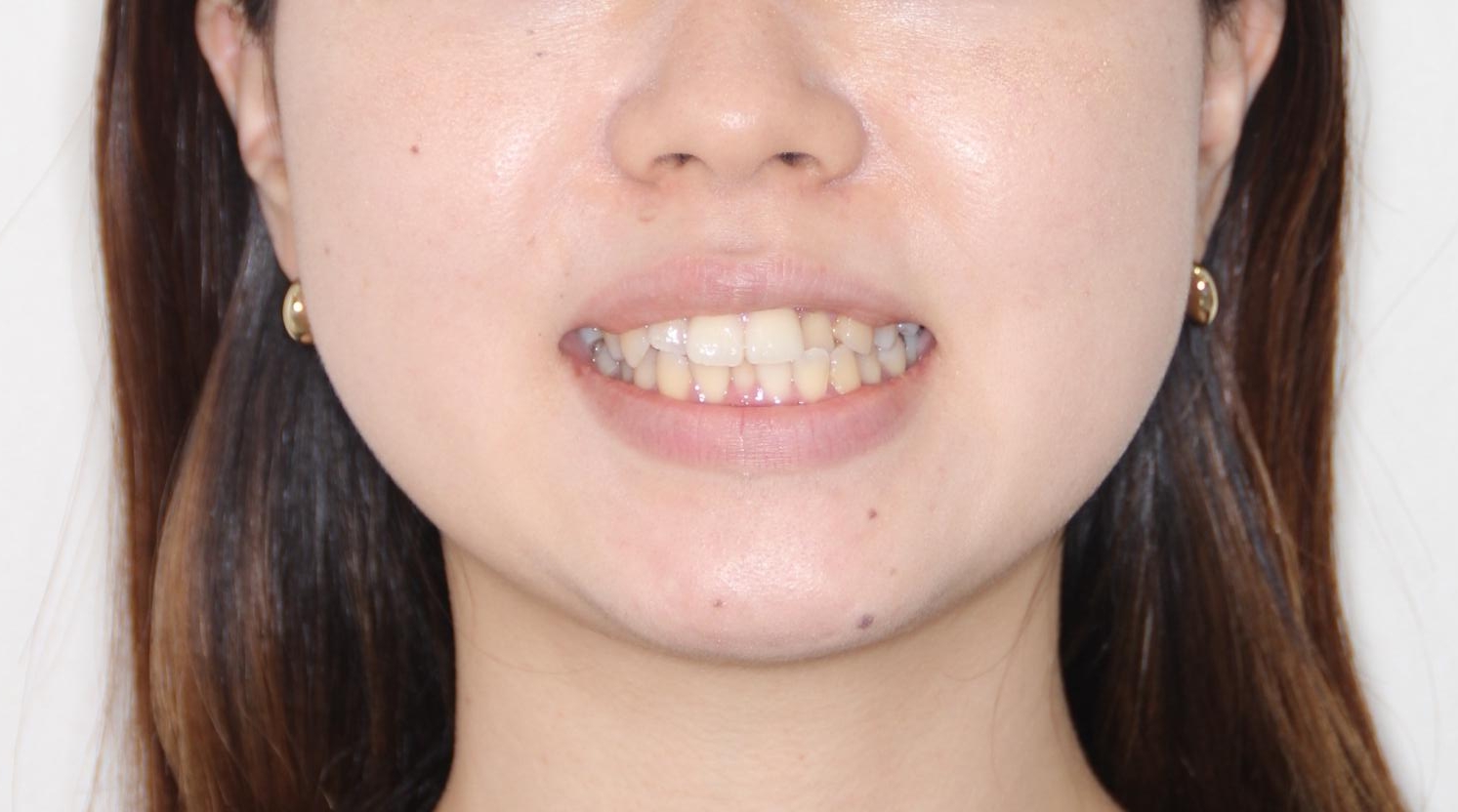 【ワイヤー矯正】口元を下げたい、下の歯の凹凸を無くしたいの治療前(顔貌)
