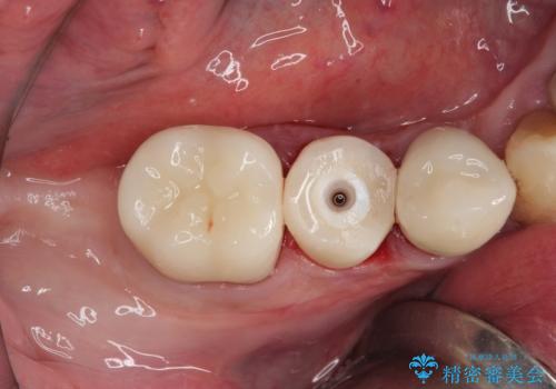 破折してしまった奥歯　抜歯即時埋入で短期間インプラント治療の治療中
