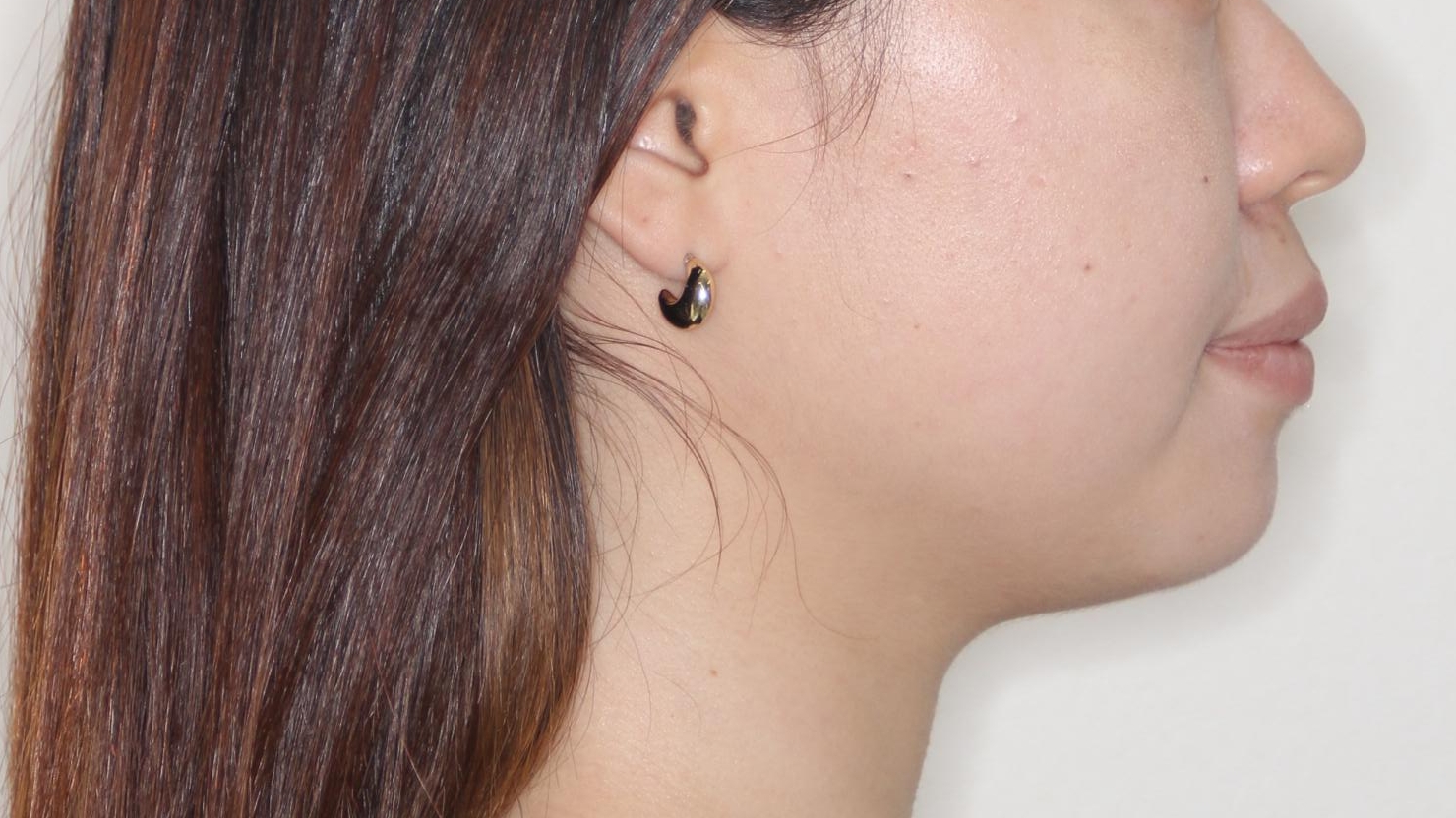 【ワイヤー矯正】口元を下げたい、下の歯の凹凸を無くしたいの治療前(顔貌)