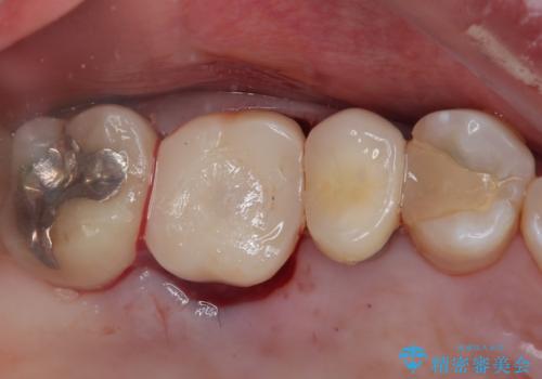 割れてしまった奥歯　1DAYインプラント治療の治療中