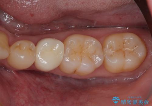 左下にフロスを通すと引っかかる オールセラミッククラウンの症例 治療後