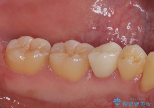 左下にフロスを通すと引っかかる オールセラミッククラウンの治療後