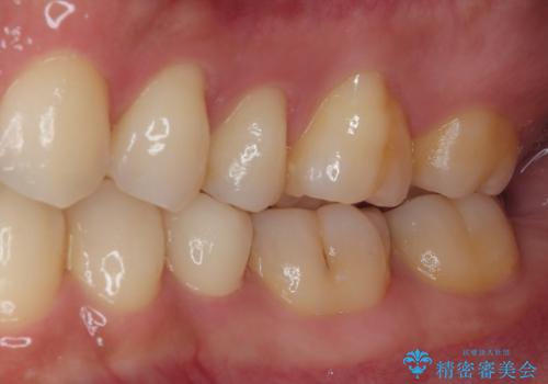 左下にフロスを通すと引っかかる オールセラミッククラウンの治療後