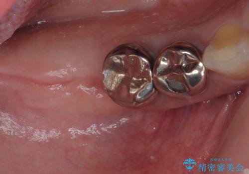 他院で抜歯をしたのでインプラントを入れたい　インプラント治療の症例 治療前