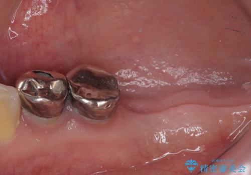 他院で抜歯をしたのでインプラントを入れたい インプラント治療の治療前
