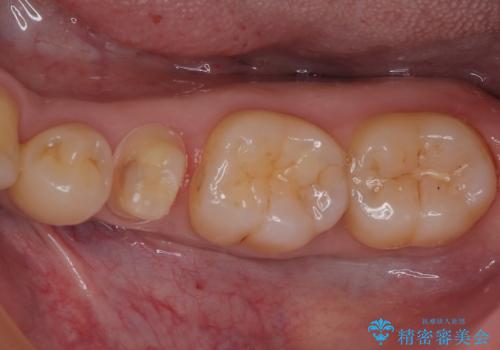 左下にフロスを通すと引っかかる　オールセラミッククラウンの治療中