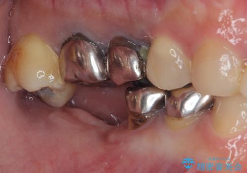 他院で抜歯をしたのでインプラントを入れたい　インプラント治療の治療前