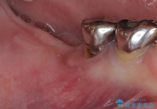 他院で抜歯をしたのでインプラントを入れたい インプラント治療の治療前