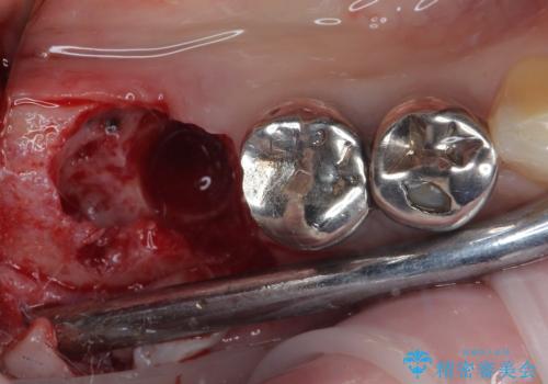 他院で抜歯をしたのでインプラントを入れたい インプラント治療の治療中
