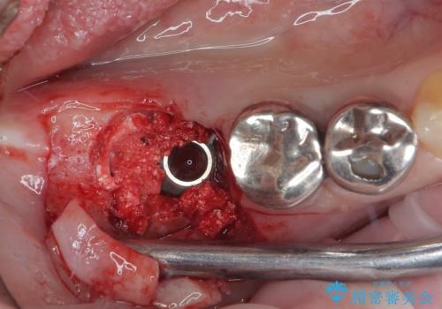 他院で抜歯をしたのでインプラントを入れたい インプラント治療の治療中