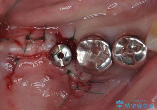 他院で抜歯をしたのでインプラントを入れたい　インプラント治療の治療中