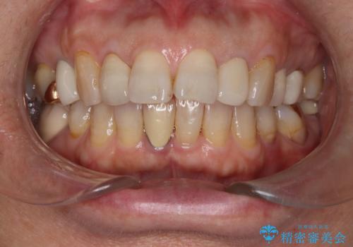 セラミッククラウン作成の為のオフィスホワイトニングの治療前