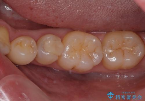 左下にフロスを通すと引っかかる オールセラミッククラウンの症例 治療前