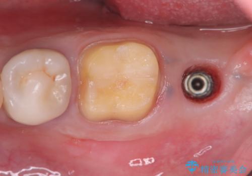 歯根嚢胞と瘻孔を伴う奥歯を抜歯即時インプラントで治療|一回の手術で改善!|インプラントの治療期間3か月の治療中