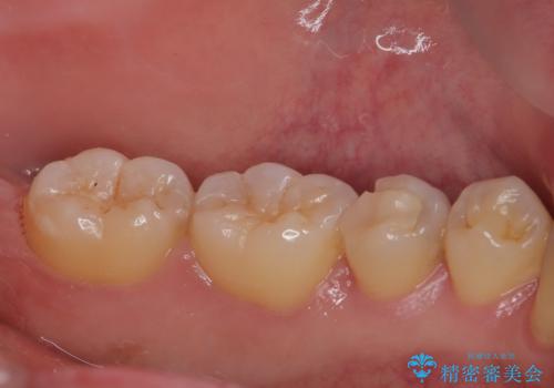 左下にフロスを通すと引っかかる オールセラミッククラウンの治療前