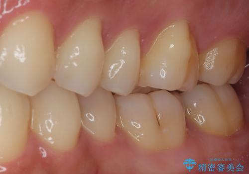 左下にフロスを通すと引っかかる　オールセラミッククラウンの治療前