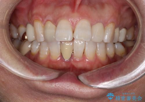 セラミッククラウン作成の為のオフィスホワイトニングの治療後