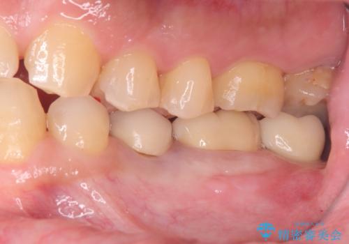 歯根嚢胞と瘻孔を伴う奥歯を抜歯即時インプラントで治療|一回の手術で改善!|インプラントの治療期間3か月の治療後