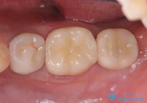 歯根嚢胞と瘻孔を伴う奥歯を抜歯即時インプラントで治療|一回の手術で改善!|インプラントの治療期間3か月の治療後