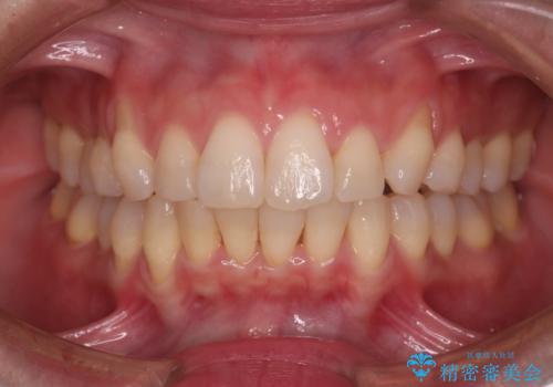 【インビザライン】上の前歯出ているのが気になるの治療後