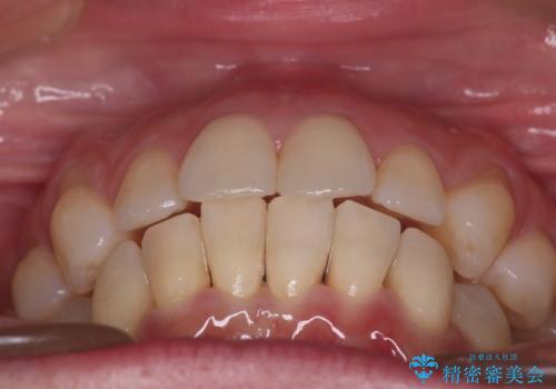 【インビザライン】上の前歯出ているのが気になるの治療後