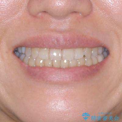 受け口と八重歯を改善 インビザライン矯正治療の治療後(顔貌)