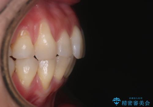 【インビザライン】上の前歯出ているのが気になるの治療後