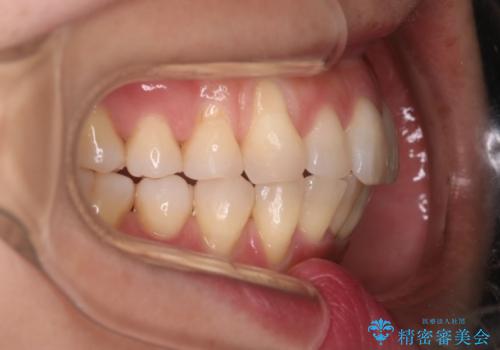 【インビザライン】上の前歯出ているのが気になるの治療後