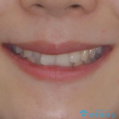前歯が隠れるほどのデコボコをインビザライン矯正できれいに整えるの治療前(顔貌)