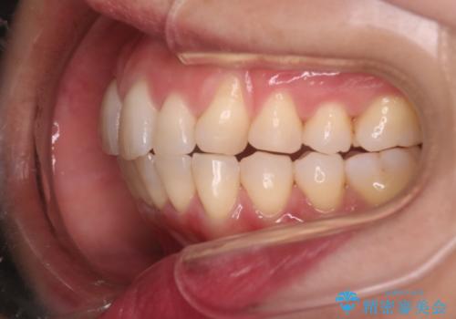 【インビザライン】上の前歯出ているのが気になるの治療後