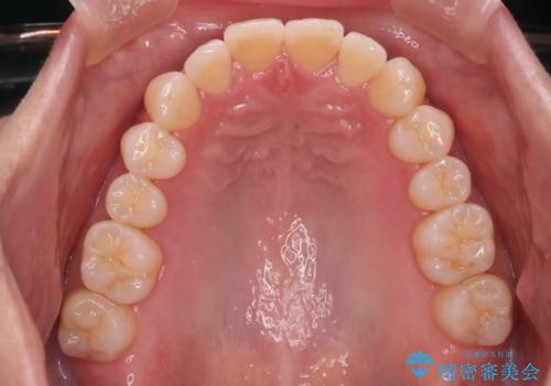 【インビザライン】上の前歯出ているのが気になるの治療後