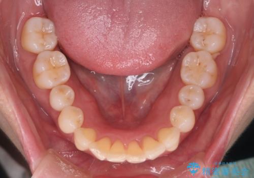 【インビザライン】上の前歯出ているのが気になるの治療後