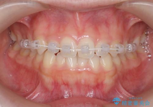前歯のねじれ、がたつきをしっかり改善 部分ワイヤー+マウスピース矯正の治療中