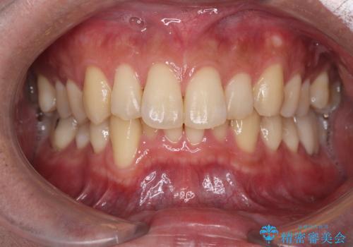 白い歯で清潔感get!初ホワイトニングの治療前