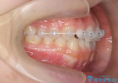 前歯のねじれ、がたつきをしっかり改善 部分ワイヤー+マウスピース矯正の治療中