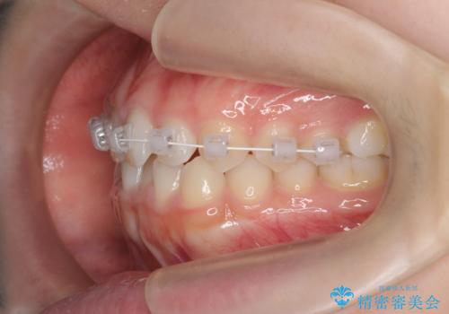 前歯のねじれ、がたつきをしっかり改善　部分ワイヤー+マウスピース矯正の治療中