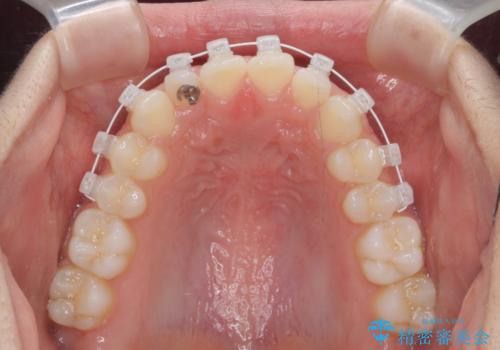 前歯のねじれ、がたつきをしっかり改善　部分ワイヤー+マウスピース矯正の治療中