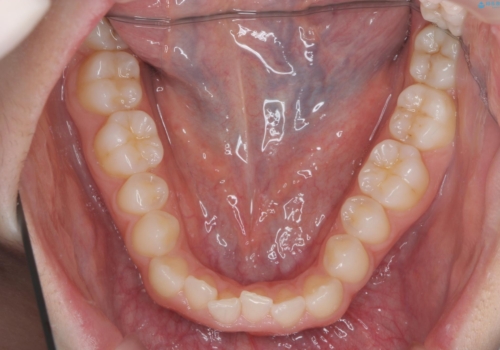 前歯のねじれ、がたつきをしっかり改善　部分ワイヤー+マウスピース矯正の治療中