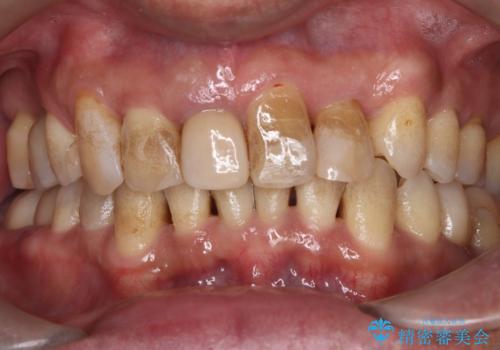 定期エアフローでスッキリ清潔!の治療前