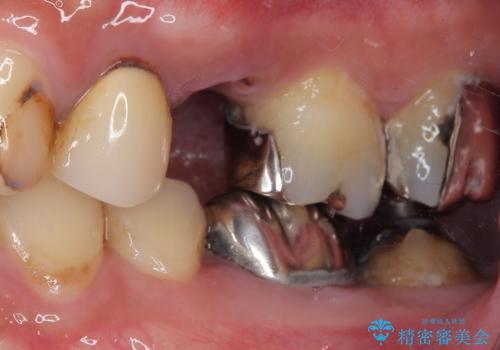 外科処置は1回のみ|抜歯即時インプラントで小臼歯を短期間で機能・審美回復した症例の治療前