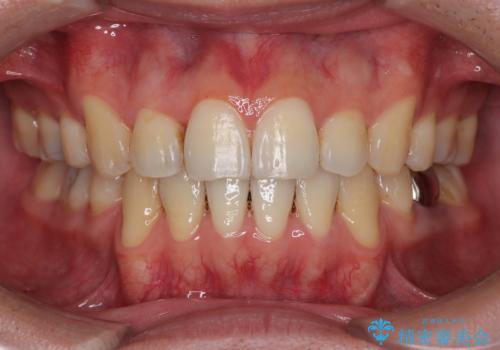 口が閉じにくい原因を根本から改善|上下顎4本抜歯による矯正治療症例の症例 治療後