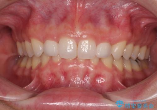 前歯のデコボコと小さい歯を改善　インビザラインとオールセラミッククラウンの症例 治療後