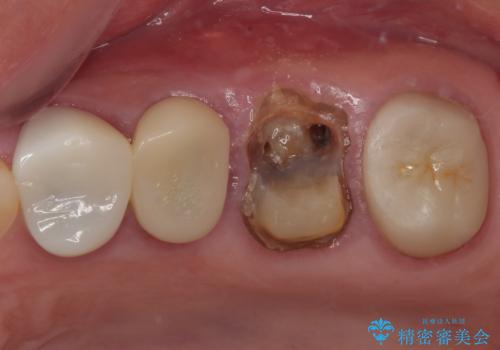 予後不良の奥歯 抜歯即時埋入インプラントによる補綴治療の症例 治療前